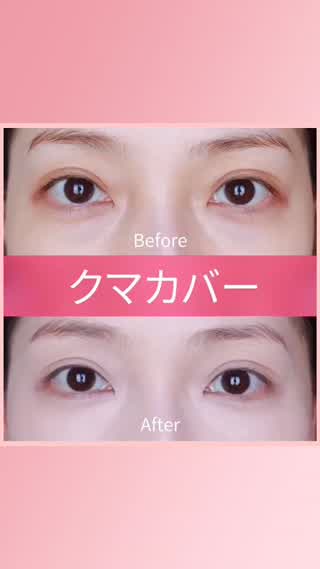 クマカバーで1番重要なコンシーラーの使い方♡