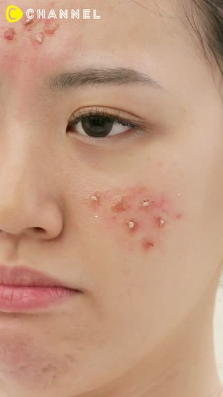 Kandungan Untuk Wajah Berjerawat