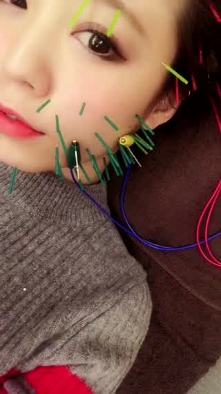 小顔・眼精疲労に効く！！おすすめ美容鍼の紹介(灬ºωº灬)