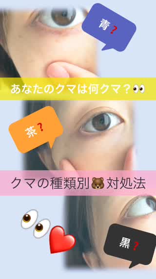 目の下のクマ《セルフチェックで分かる》タイプ別対処法