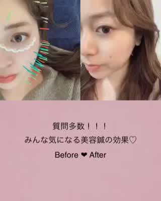＊みんな気になる！話題の美容鍼