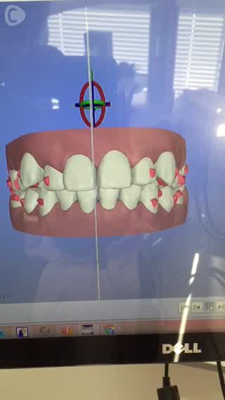 3Dシミュレーションでしっかり計画！マウスピース矯正するならトルナーレ歯科！