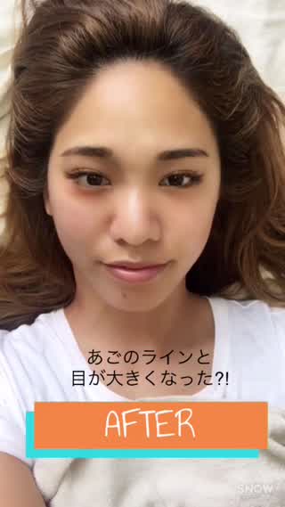 即効小顔⁈ 話題の美容鍼を初体験